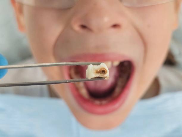 Best Emergency Root Canal Treatment in Fortville, IN