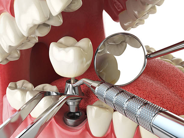 Best Emergency Dentist for Knocked-Out Tooth in Fortville, IN